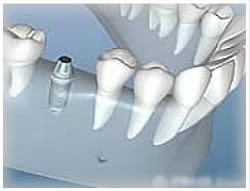 ., best dentist for implants