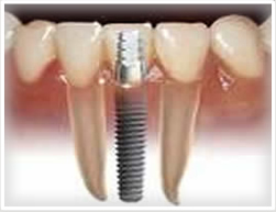 dental tourism implants