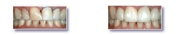 Before and after picture of a patient's teeth who received porcelain dental crowns from Dr. Foroud Tale-Yazdi, D.D.S. at lake Forest Dental Healthcare