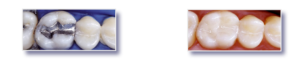 Image of silver fillings versus white fillings