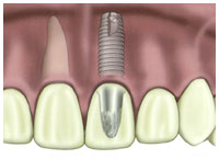 Dental Implants