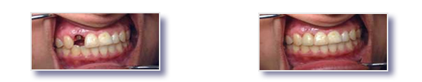 Dental implants before and after smile with missing tooth before and beautiful teeth after treatment from Lake Forest Dental